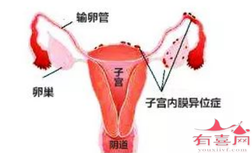 子宫内膜异位症的可能原因